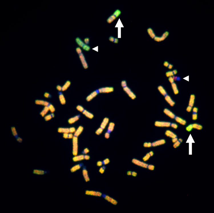 Gain of chromosome 11p in an HRAS mutant Spitz tumor